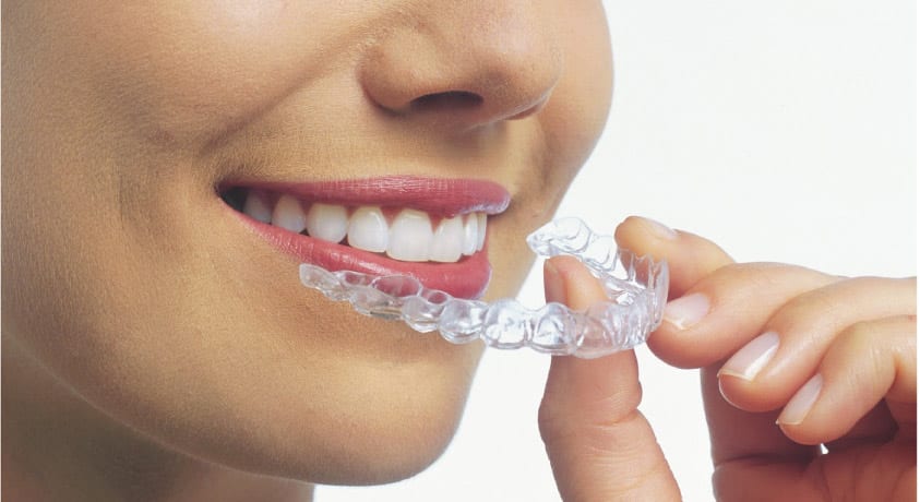woman inserting invisalign dental aligner
