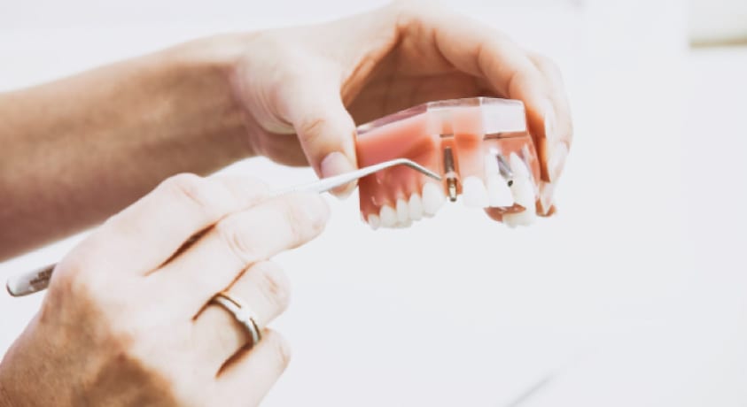 hands demonstrating a dental implant model