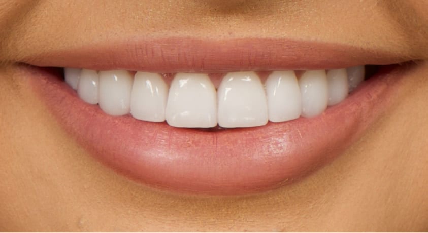 woman's smile with dental veneers