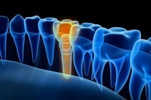 affordable dental implants in cary, north carolina