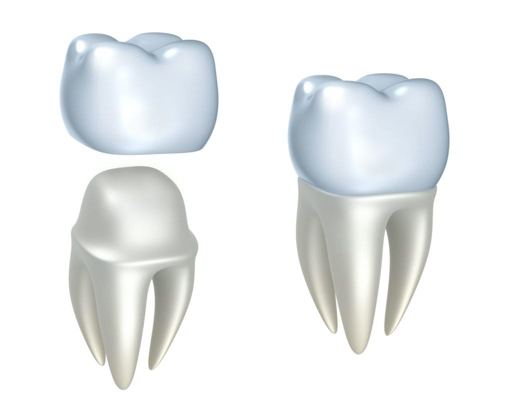 restorative dental crowns in Cary North Carolina