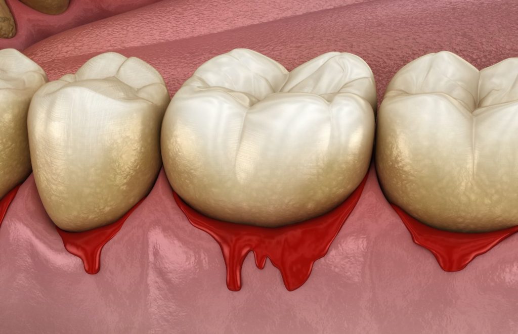 bleeding gums treatment in Cary North Carolina