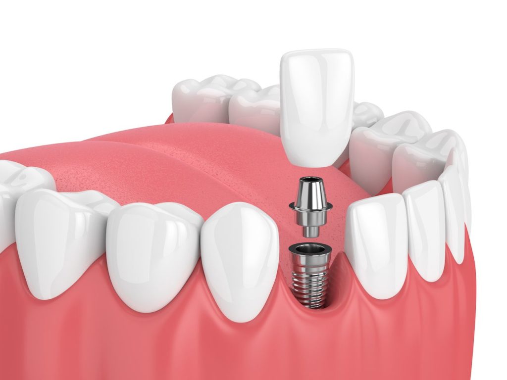 dental implant patients Cary North Carolina