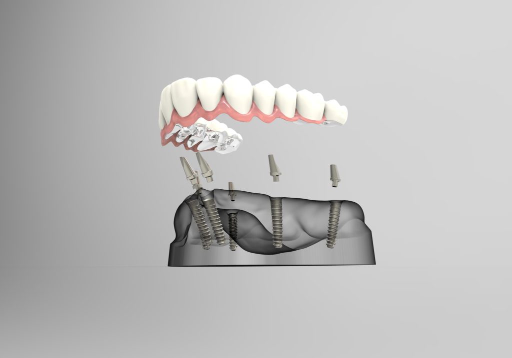Dental Implants vs Dentures Cary NC