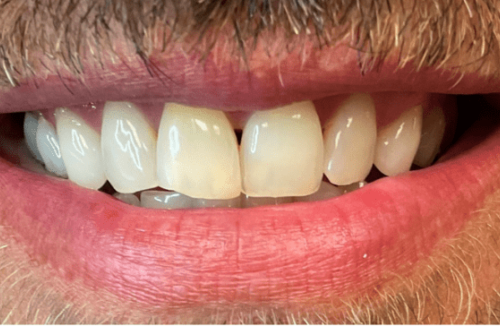 Cosmetic dental results in Cary North Carolina