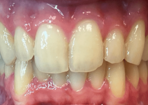 Cosmetic dental results in Cary North Carolina