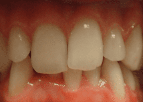 Cosmetic dental results in Cary North Carolina