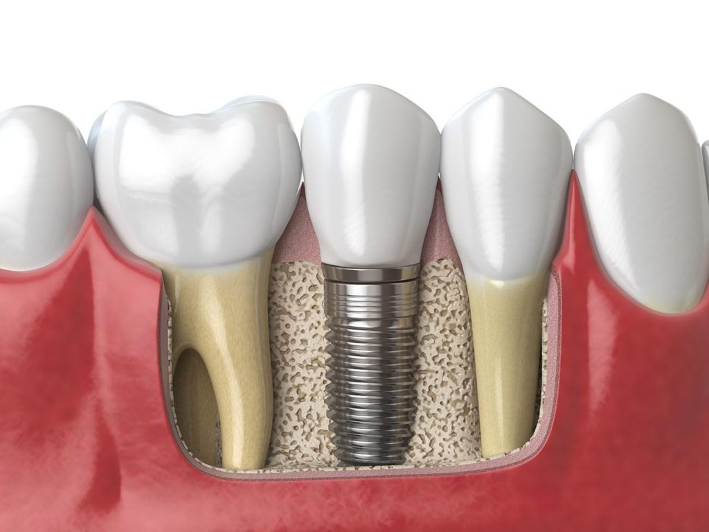 dental implant aftercare advice