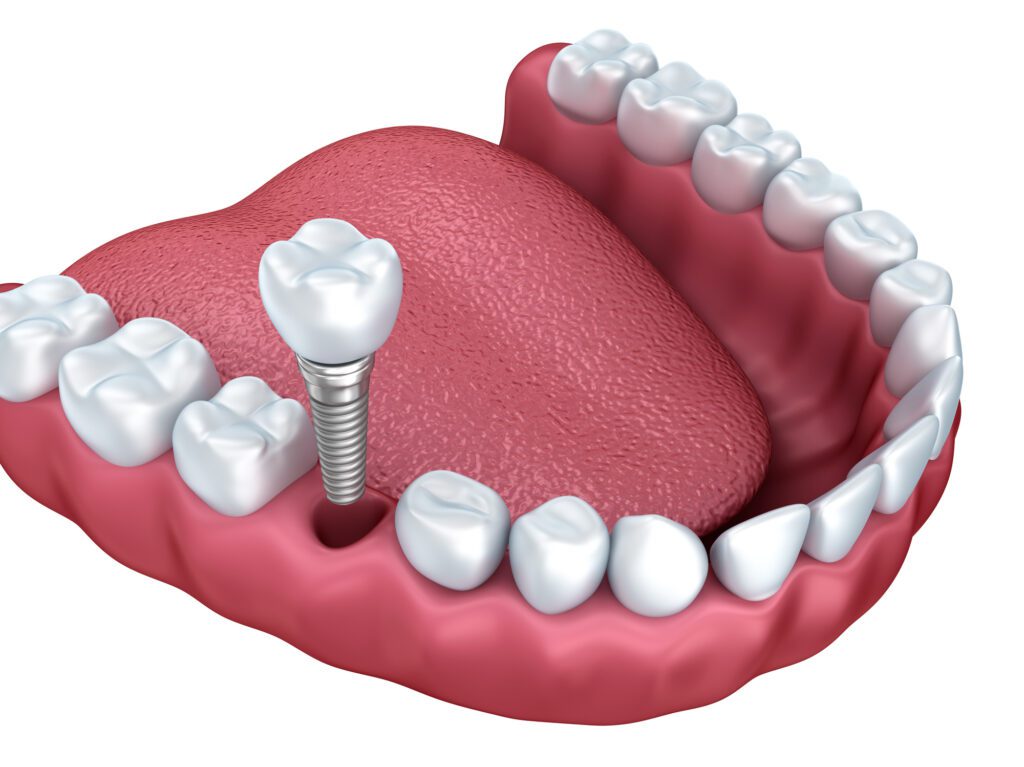 Single Dental Implant Cary, NC