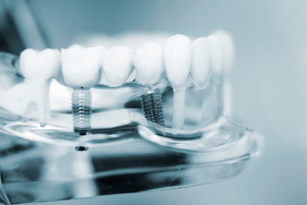 Step-By-Step Dental Implants