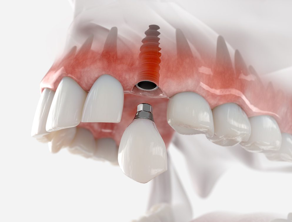 Dental implants could help restore your smile after losing teeth