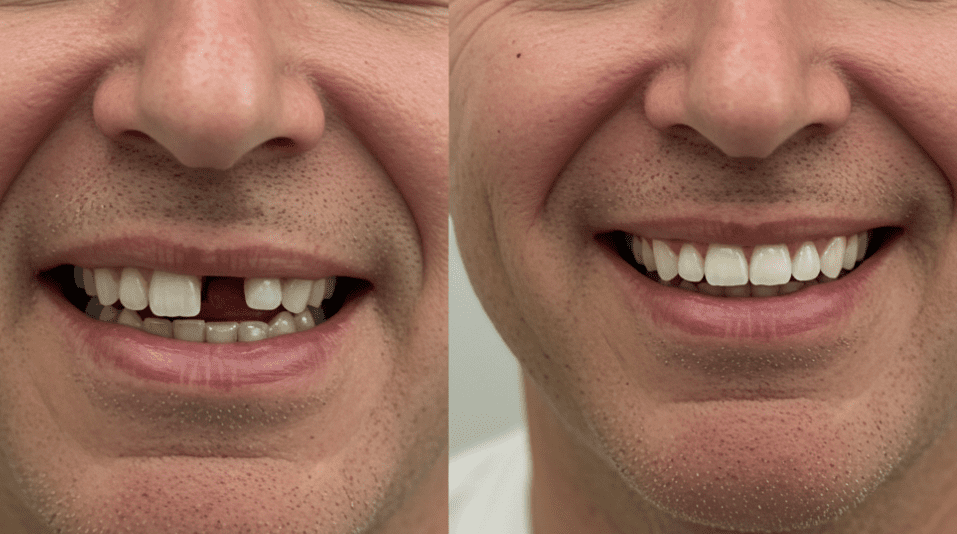 Before and after dental implant for front tooth