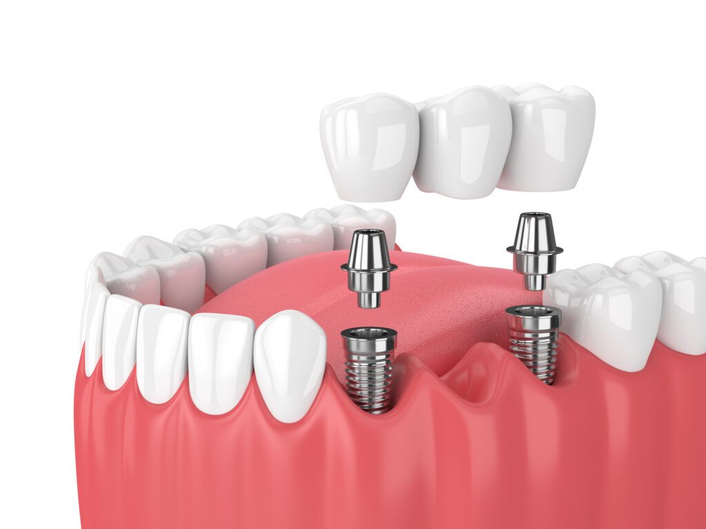 Multiple dental implants Cary, NC