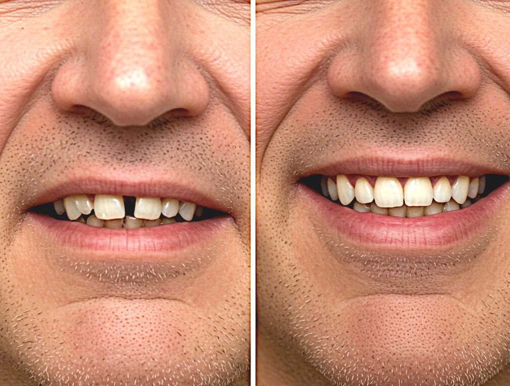 Veneers in Cary, NC
