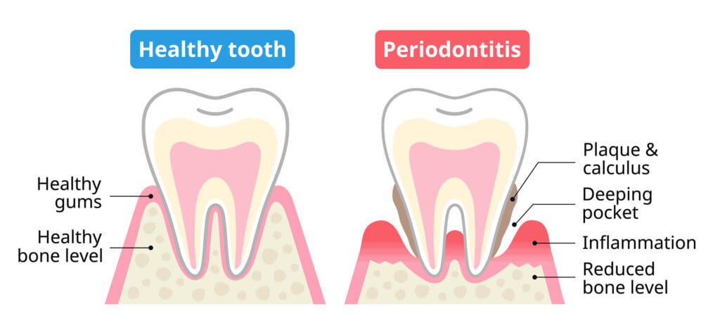 Address bleeding gums in Cary, NC