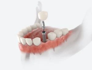 Dental Implants : A Permanent Solution for Your Smile in Cary, NC