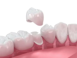 Dental Crowns: When a Tooth Needs a Second Chance in Cary, NC
